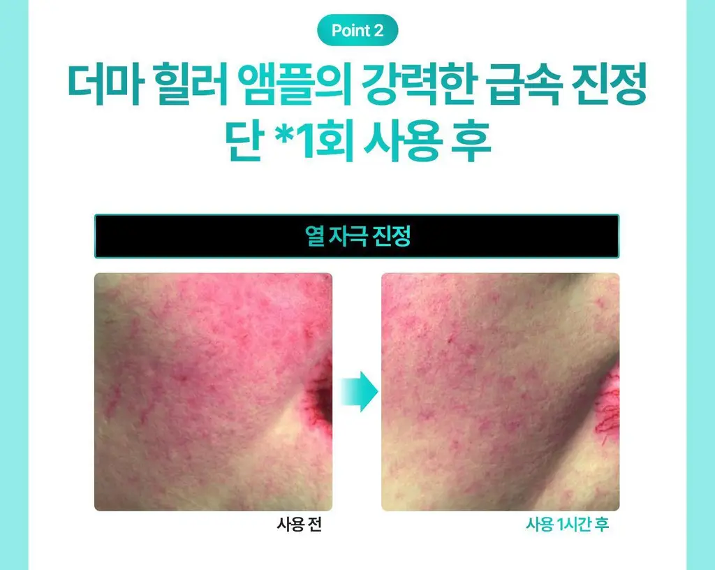[리쥬란 독자소재_강력진정PDRx] 리쥬란 더마 힐러 모이스처 트리트먼트 앰플 30ml [기획(+마스크1매)/단품] 상세페이지 14